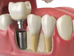 Dental Implants Cost 
