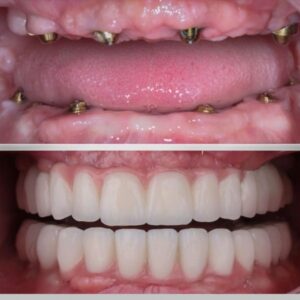 Before-and-After-Dental