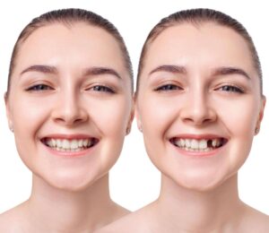 Before and After Results