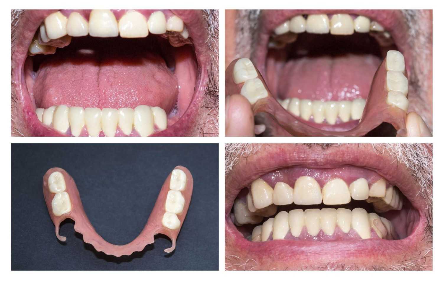 Tooth Replacement