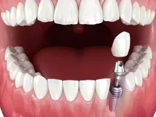 Front Teeth Implants e1779285614373