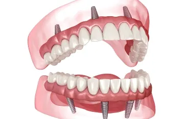 Full Mouth Implant