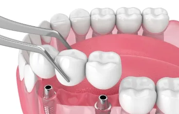 Same Day Implant