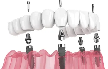 Zygomatic Implants