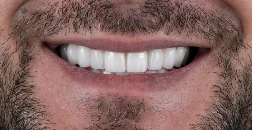 After Composite Bonding Perfectsmile Dental