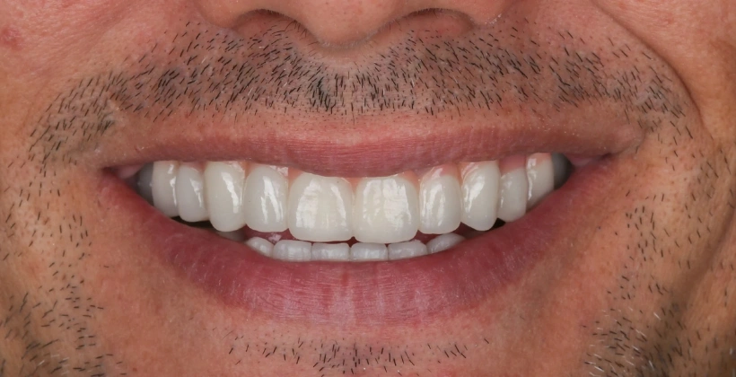After Dental Bridge 1