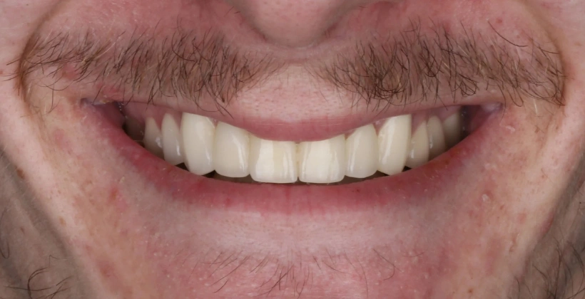 After Dental Bridge