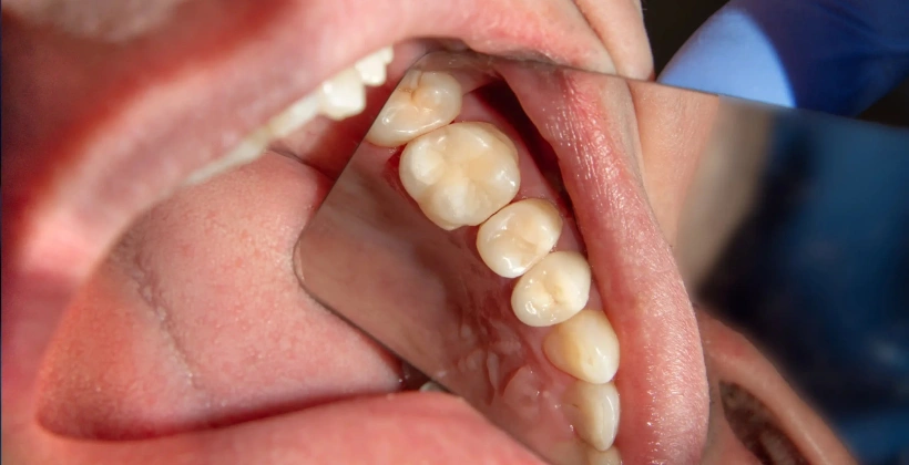 After Invisible White Fillings 1