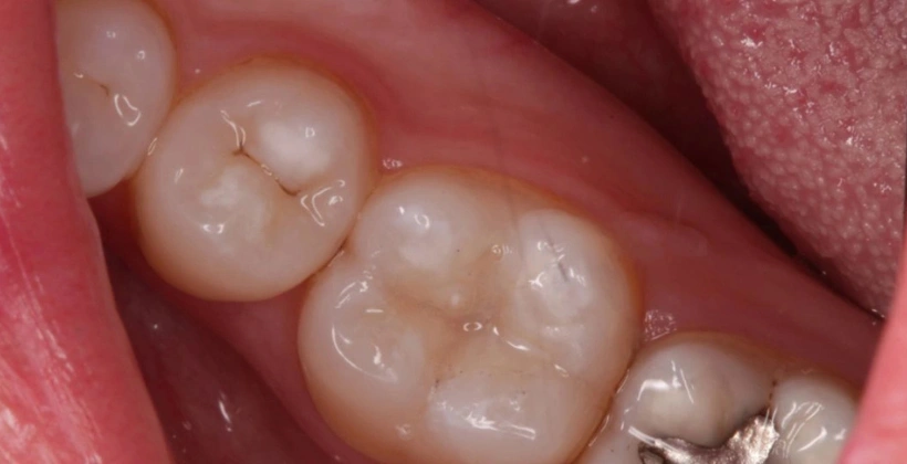 After Invisible White Fillings