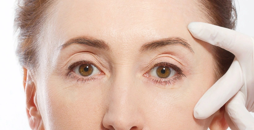 After Juvederm Fillers 1