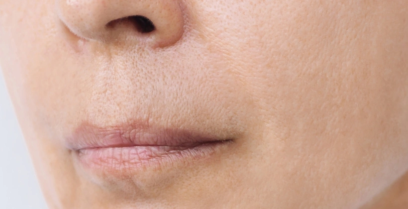 After Juvederm Fillers