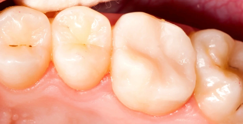 After Restorative Treatments