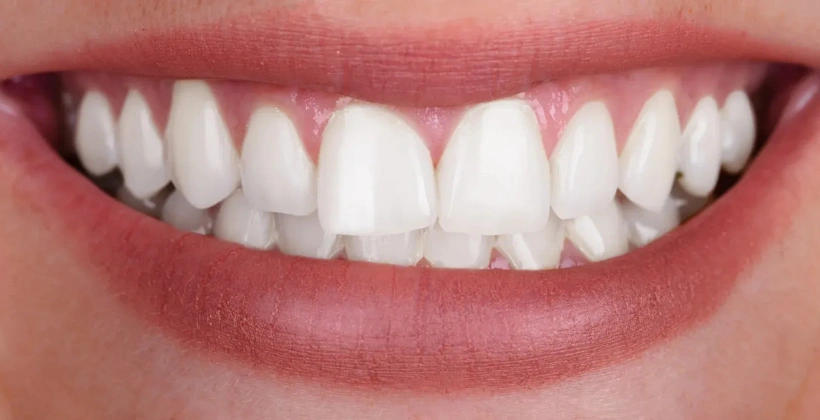 After Teeth Whitening Perfectsmile Dental