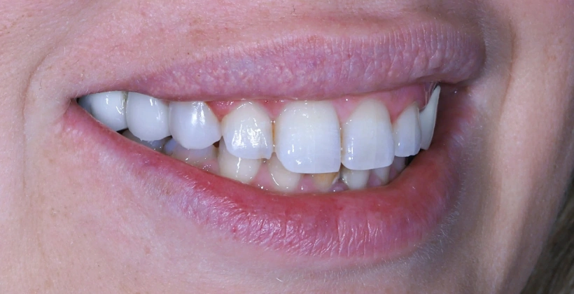After Tooth Decay Treatment