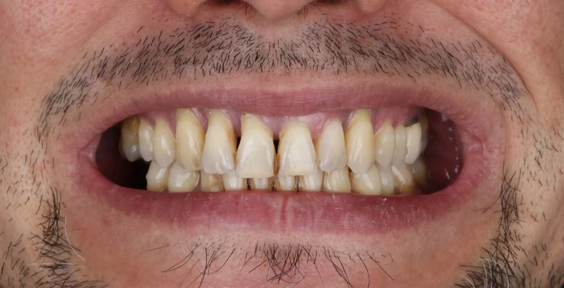 Before Dental Bridge 1
