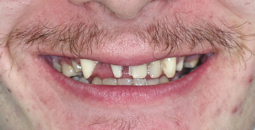 Before Dental Bridge