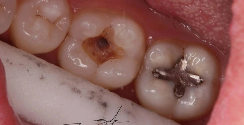 Before Invisible White Fillings