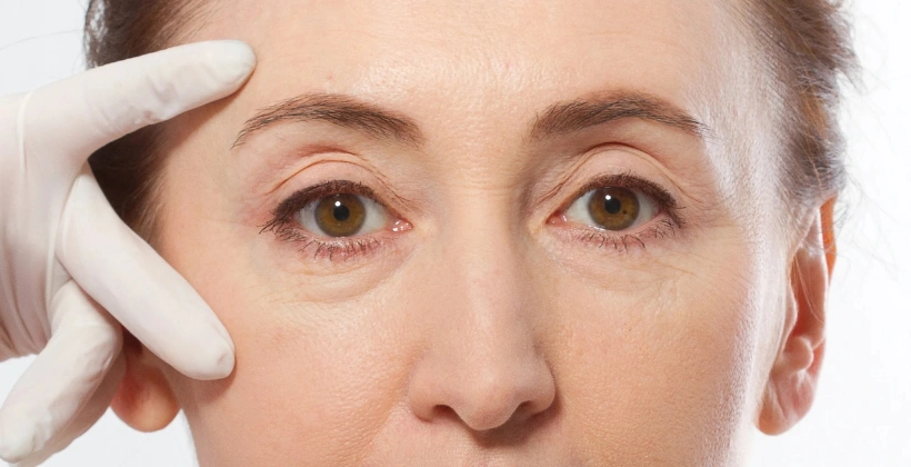 Before Juvederm Fillers 1