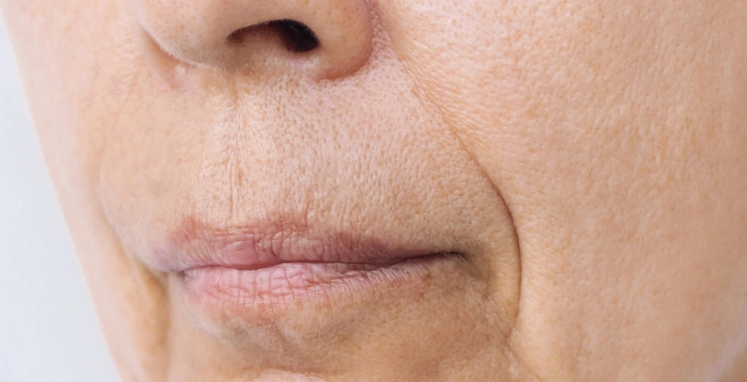 Before Juvederm Fillers