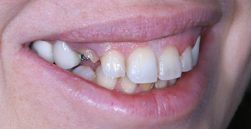 Before Tooth Decay Treatment