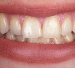 Before whitening treatment
