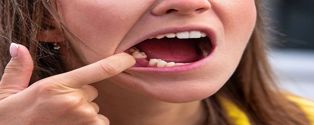 Losing Teeth? Here are Three Best Alternatives That Won’t Ruin Your Smile