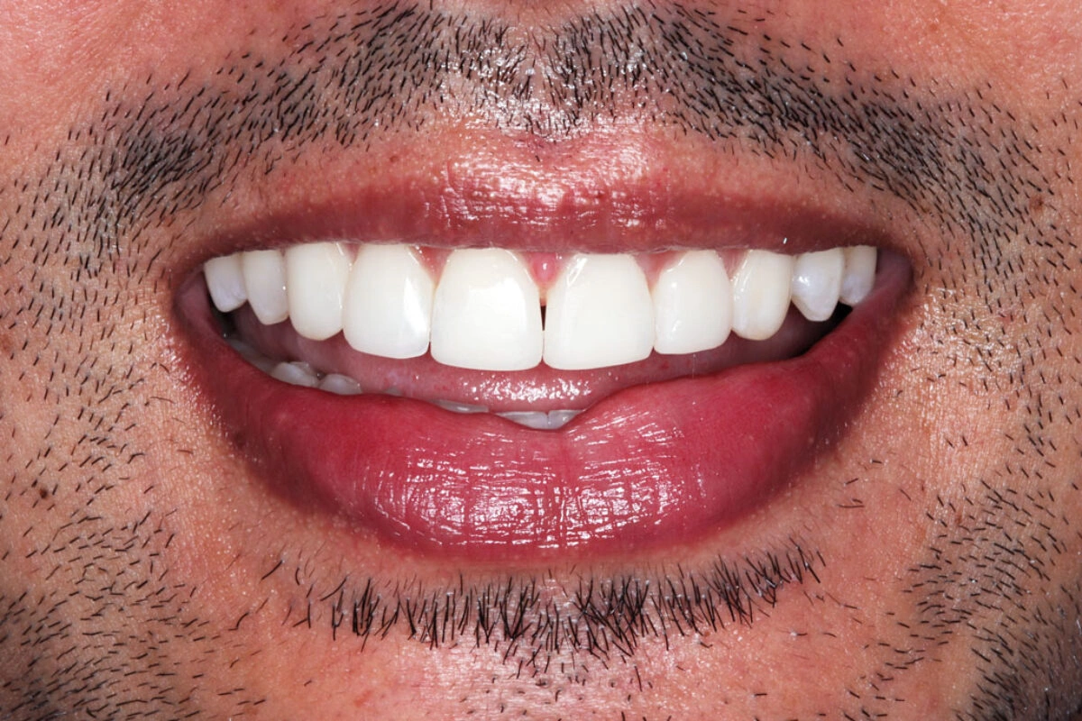 Composite Bonding after