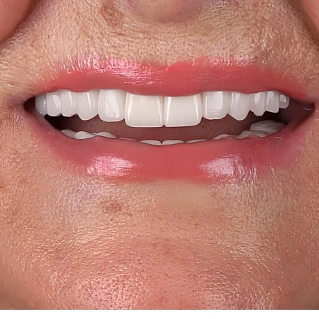 Dental Implants after