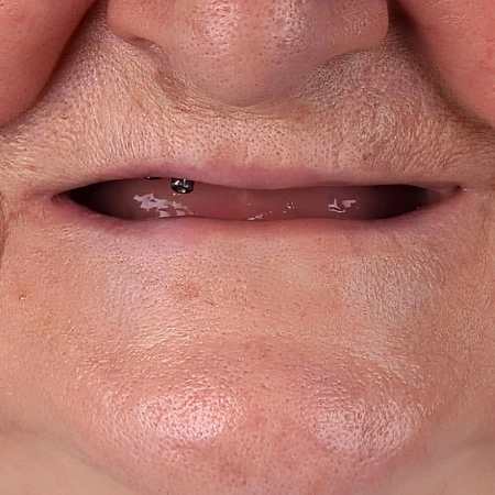 Dental Implants before