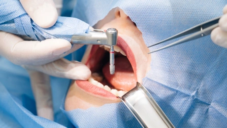 Implant Placement DI