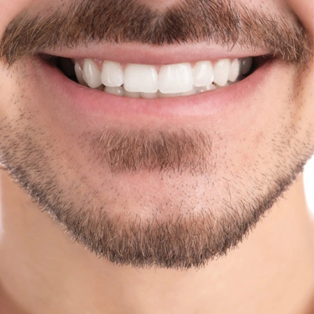 Invisalign (Clear Braces) after