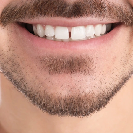 Invisalign (Clear Braces) before