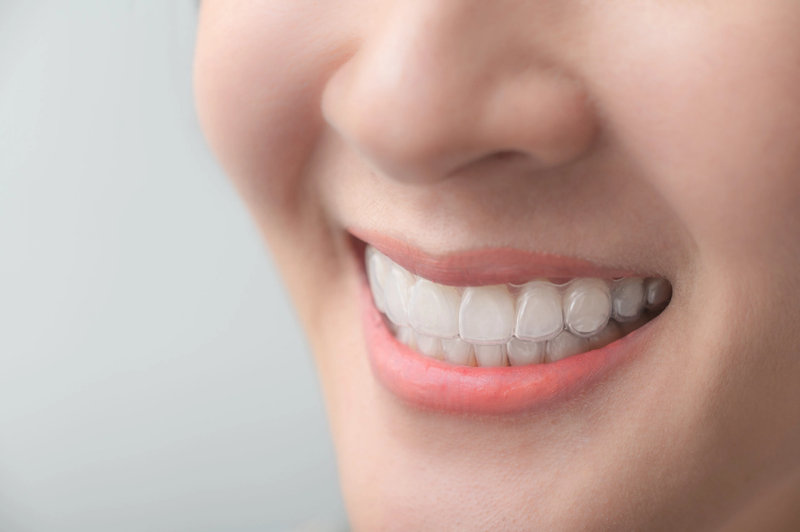 The Role of Invisalign in Overbite Correction: What You Need to Know