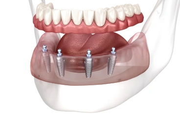 Jawbone Deterioration