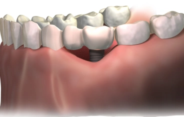 Loose or Uncomfortable Dentures