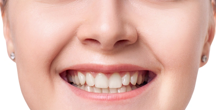 Missing front teeth After