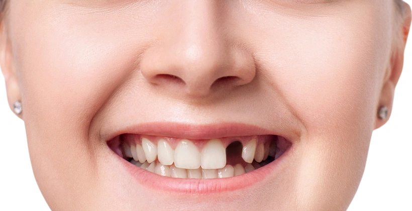 Missing front teeth Before