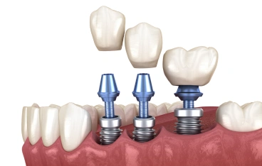 Multiple Missing Teeth