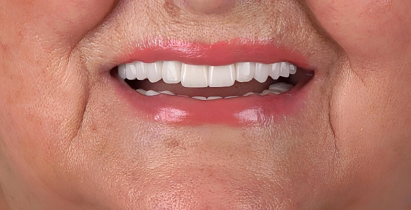 Multiple missing and teeth After