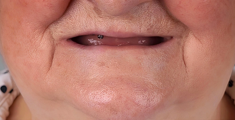 Multiple missing and teeth Before