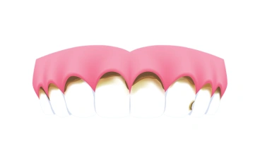 Severe Tooth Decay