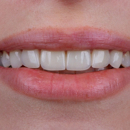 Teeth Whitening after