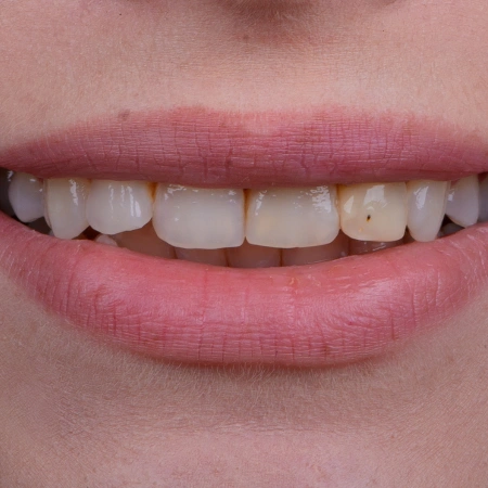 Teeth Whitening before