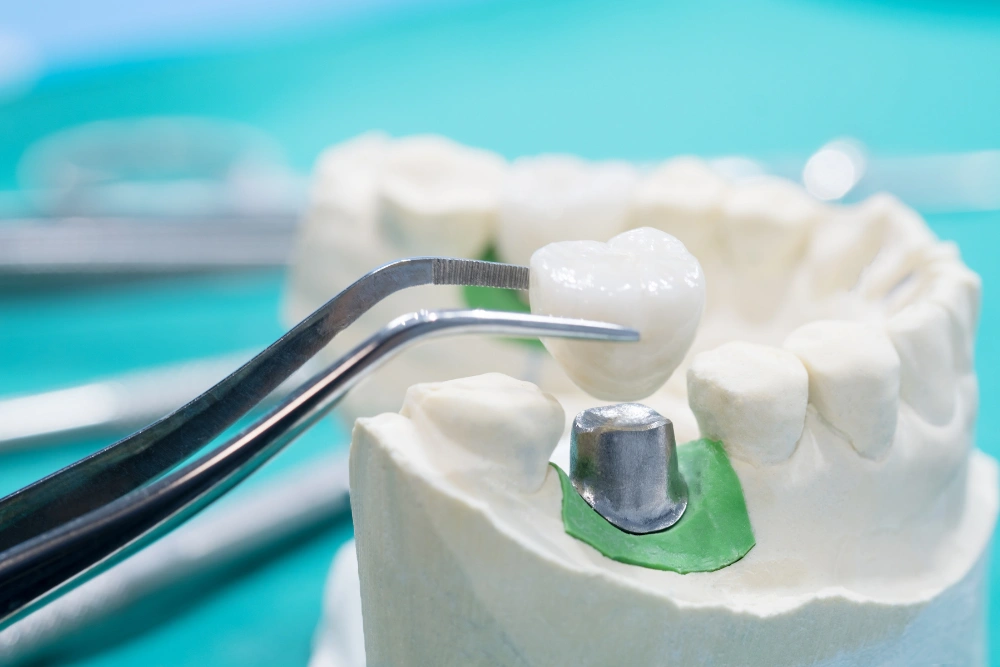 How Much Does a Dental Bridge Cost?