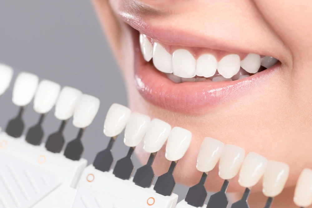 How Much Does Teeth Whitening Cost?