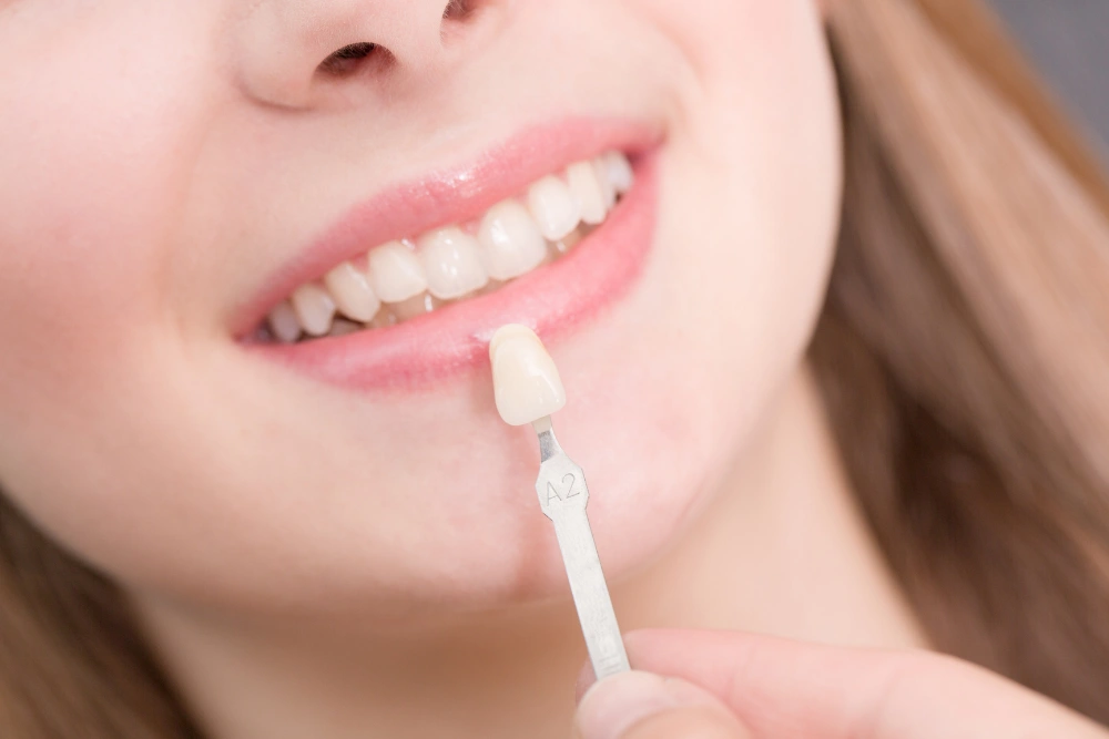 How Much Do Veneers Cost?