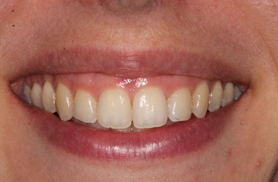 B1 1