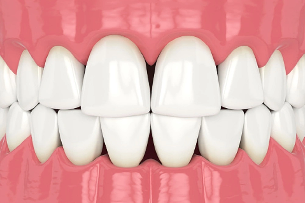 Detailed Guide On Composite Bonding Works