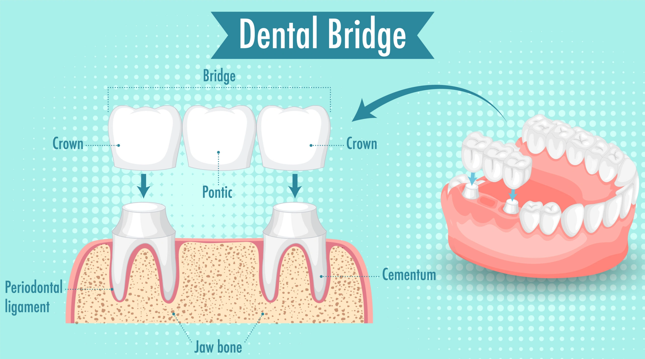 dental bridges
