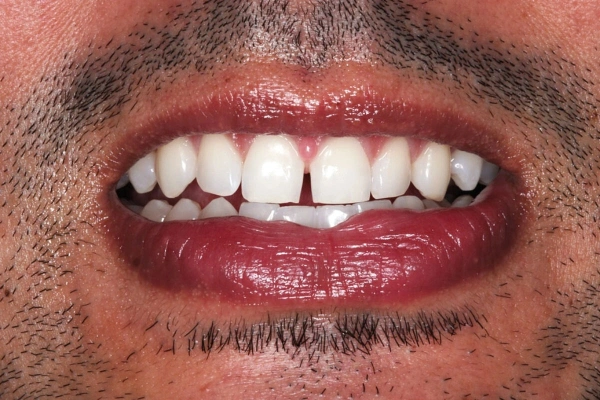 Composite Bonding before